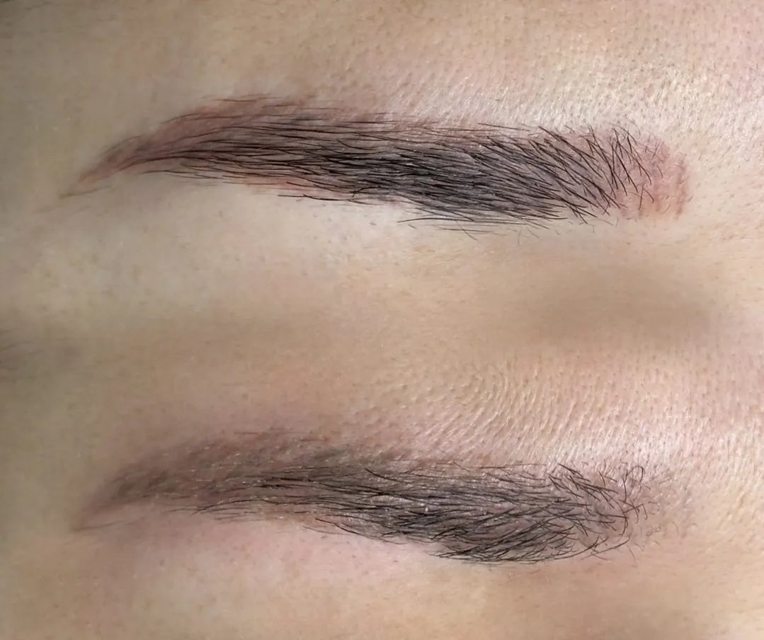 Remoción de pigmento en cejas, caso 1: comparación del pigmento anterior y la piel después del tratamiento